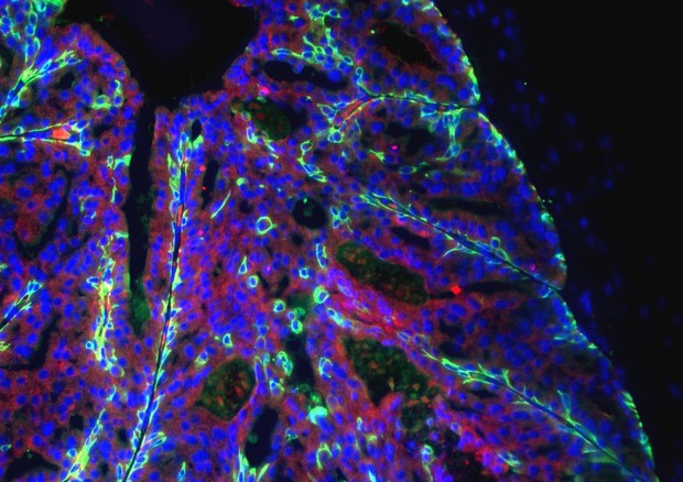 Cellule del tumore della prostata (fonte: Davide Ruggero, università della California a San Francisco) © Ansa