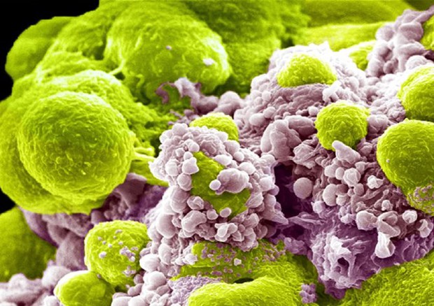 Cellule del tumore alla prostata © Ansa