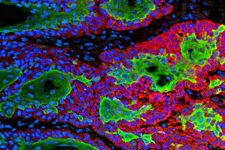Cellule tumorali (fonte: Markus Schober, Elaine Fuchs, The Rockefeller University, New York) - RIPRODUZIONE RISERVATA