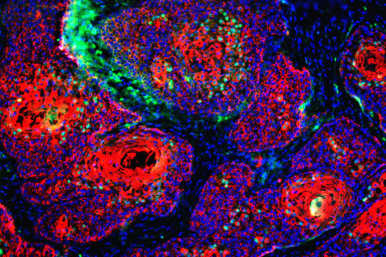Cellule tumorali (fonte: Elisabetta Palazzo, Ph.D., NIAMS Laboratory of Skin Biology, Maria I. Morasso, Ph.D., Chief, NIH/NIAMS, Flickr) - RIPRODUZIONE RISERVATA
