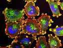 Cellule di melanoma (fonte: NIH) (ANSA)