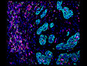In azzurro chiaro le cellule del tumore testa-collo (fonte: Romain Remark, Miriam Merad e Sacha Gnjatic, Innate Pharma e Icahn School of Medicine at Mount Sinai) (ANSA)