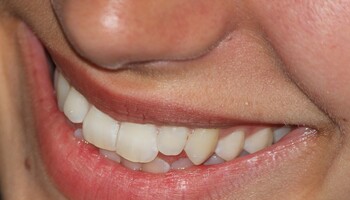 La parodontite può essere associata a molte malattie (fonte: Max Pixel) (ANSA)