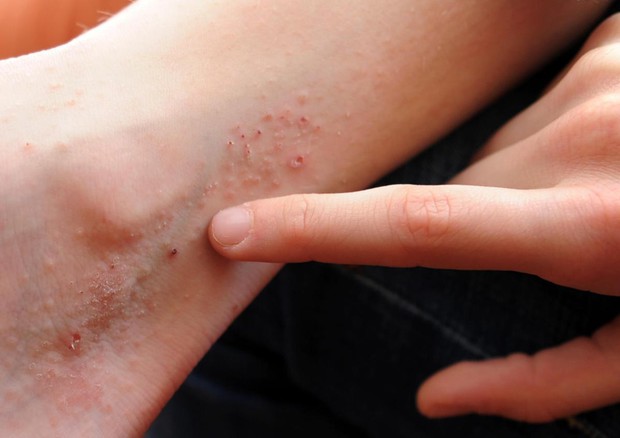 Eczema, colpisce il 6% di bambini e adolescenti nel mondo © ANSA