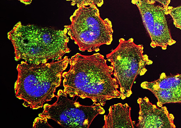 Cellule di melanoma (fonte: NIH) © Ansa