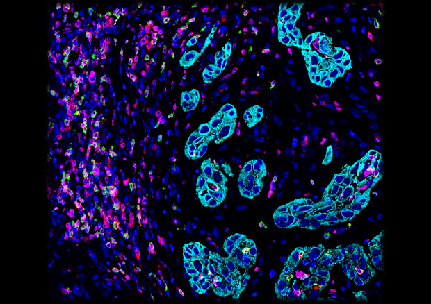 In azzurro chiaro le cellule del tumore testa-collo (fonte: Romain Remark, Miriam Merad e Sacha Gnjatic, Innate Pharma e Icahn School of Medicine at Mount Sinai) © Ansa