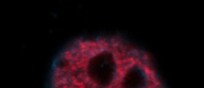  Cellule di carcinoma della cervice uterina trattate con un farmaco chemioterapico che induce un danno al Dna. In rosso il Dna danneggiato, in blu il DNA totale (fonte: A. Giordano, Temple University)