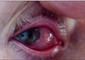 Rara e grave infezione dell'occhio © Ansa