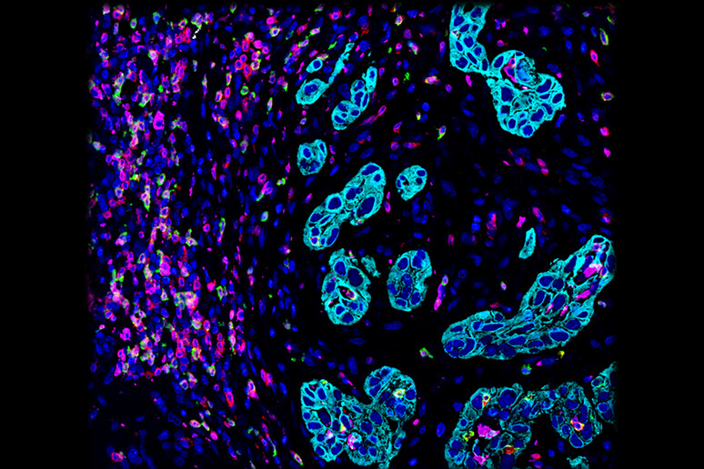 In azzurro chiaro le cellule del tumore testa-collo (fonte: Romain Remark, Miriam Merad e Sacha Gnjatic, Innate Pharma e Icahn School of Medicine at Mount Sinai) - RIPRODUZIONE RISERVATA