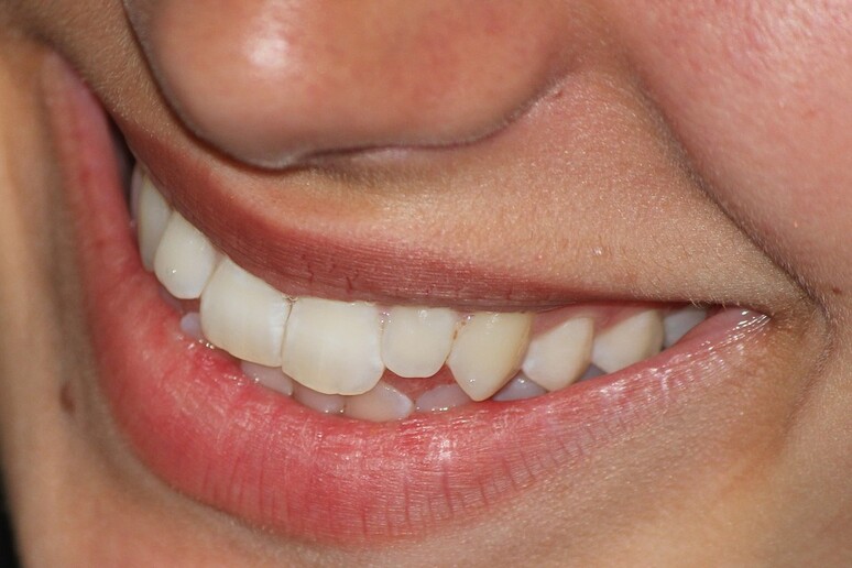La parodontite può essere associata a molte malattie (fonte: Max Pixel) - RIPRODUZIONE RISERVATA