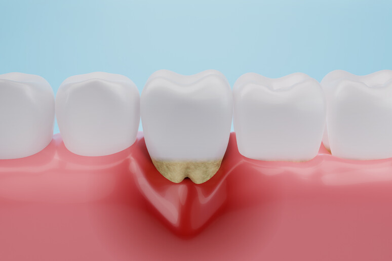 Anche chi ha la parodontite può prendere i farmaci salva-ossa - RIPRODUZIONE RISERVATA